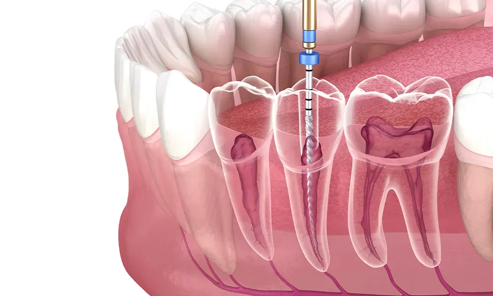 Paciente recibiendo un tratamiento de conducto en Sense Dental Center en Orlando, FL