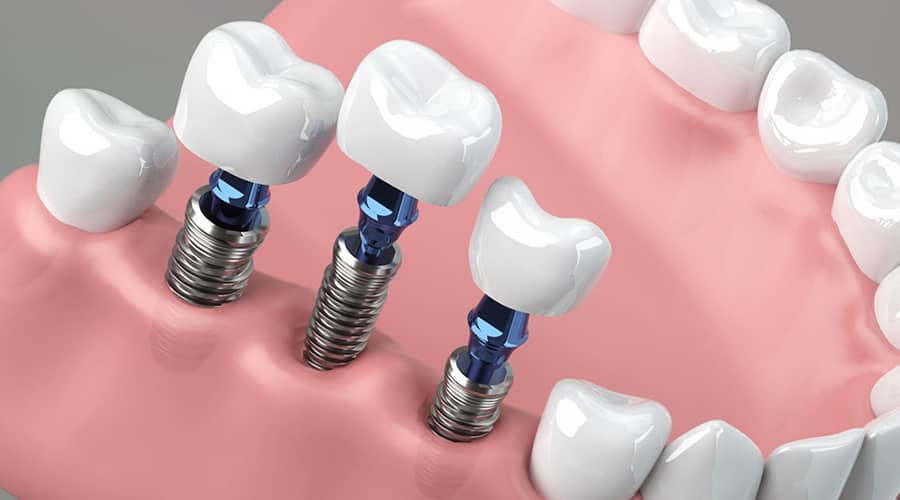 Paciente sonriendo después de la colocación de un implante dental en Sense Dental Center en Orlando, FL