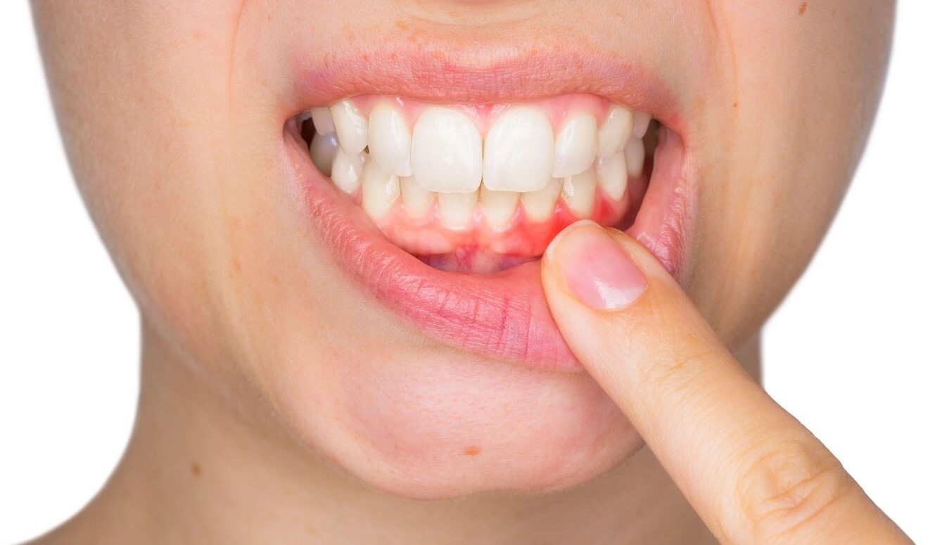 Tratamiento periodontal de enfermedad de las encías en Sense Dental Center en Orlando, FL