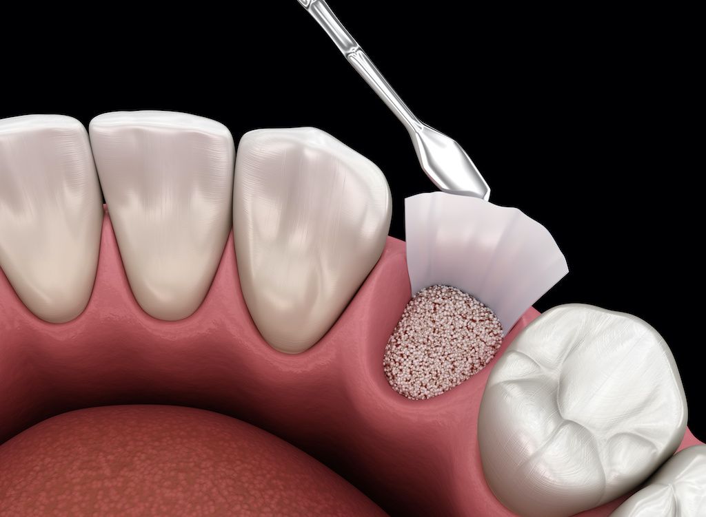 Dentista explicando um procedimento de enxerto ósseo dental a um paciente em Orlando, FL