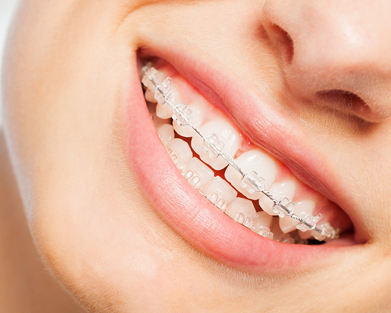 Paciente con brackets de cerámica transparentes colocados por ortodoncistas en Sense Dental Center en Orlando, FL