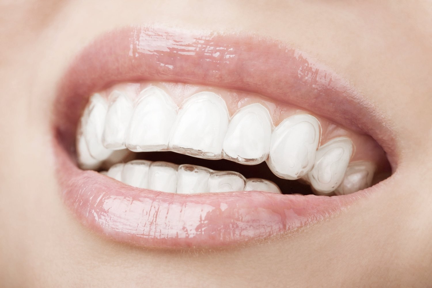 ClearCorrect clear aligner treatment for discreet teeth straightening at Sense Dental Center in Orlando, FL