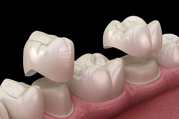 Procedimento de aumento de coroa realizado por um especialista odontológico em Orlando, FL