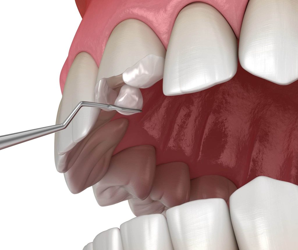 Dentista realizando un tratamiento de odontología restauradora a un paciente