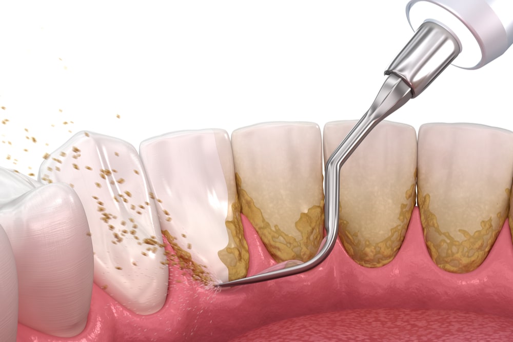 Tratamiento periodontal de raspado y alisado radicular en Sense Dental Center en Orlando, FL