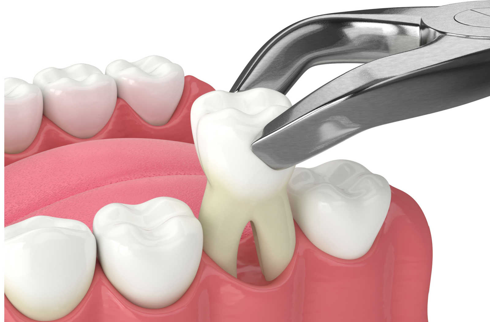 Dentista realizando uma extração dentária delicada em Orlando, FL