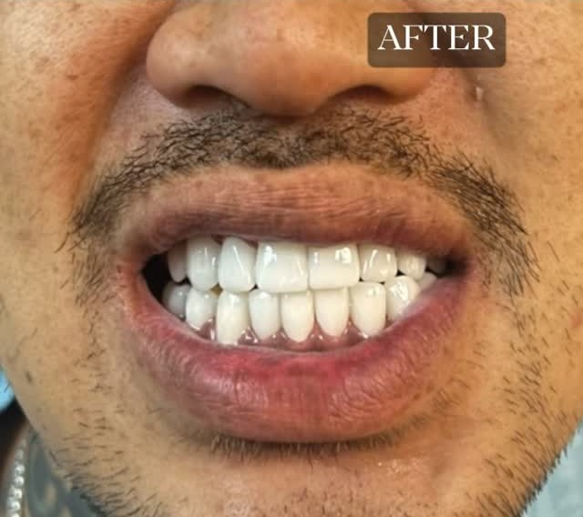 Smile preview generated by the Smile by Sense app.