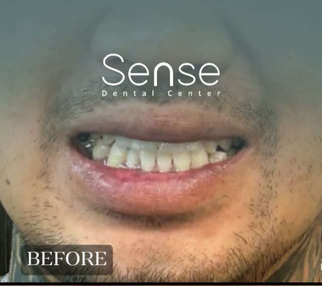 Patient smile before treatment.